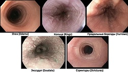 Эозинофильный эзофагит. Взрослые. Клинические рекомендации 2025 - 2027